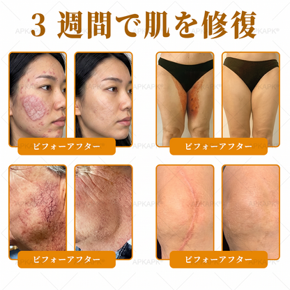 🐝皮膚科学的および臨床的にテスト済み👩‍⚕️APKAPK™ 蜂毒 (ハチドク)   肌再生クリーム🐝 シワ、傷跡、色素沈着、妊娠線、ニキビ、乾癬、湿疹、皮膚の変調、刺激、炎症、その他の皮膚トラブルといった問題の治療に役立ちます🎈