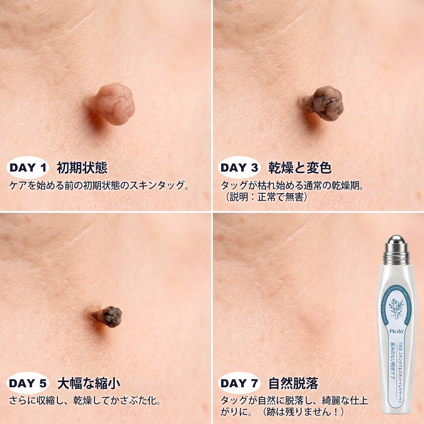 🍧公式ブランドストア  𝐏i𝐜𝐝o® 𝟕日間イボ&シミ消し(痛みも傷跡もゼロのローラーボール)