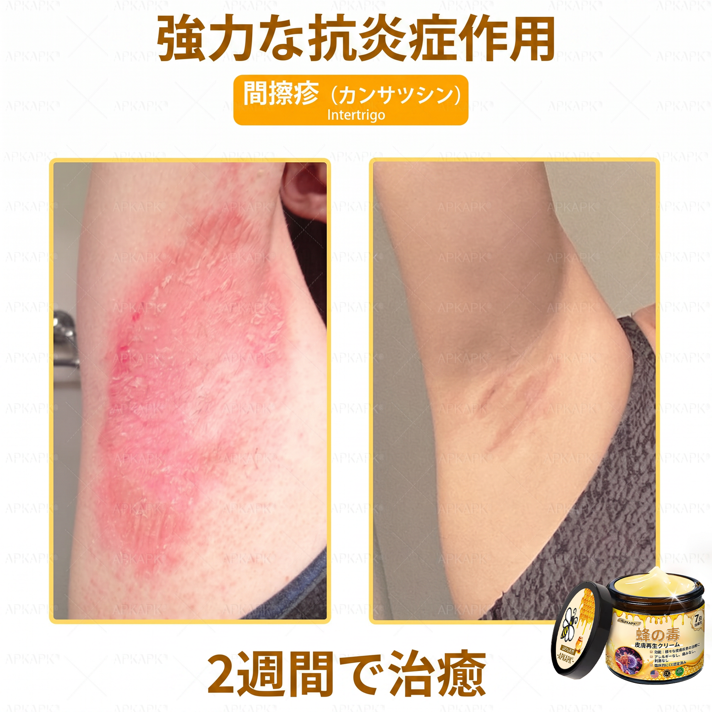🐝皮膚科学的および臨床的にテスト済み👩‍⚕️APKAPK™ 蜂毒 (ハチドク)   肌再生クリーム🐝 シワ、傷跡、色素沈着、妊娠線、ニキビ、乾癬、湿疹、皮膚の変調、刺激、炎症、その他の皮膚トラブルといった問題の治療に役立ちます🎈
