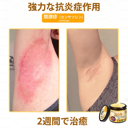 🐝皮膚科学的および臨床的にテスト済み👩‍⚕️APKAPK™ 蜂毒 (ハチドク)   肌再生クリーム🐝 シワ、傷跡、色素沈着、妊娠線、ニキビ、乾癬、湿疹、皮膚の変調、刺激、炎症、その他の皮膚トラブルといった問題の治療に役立ちます🎈