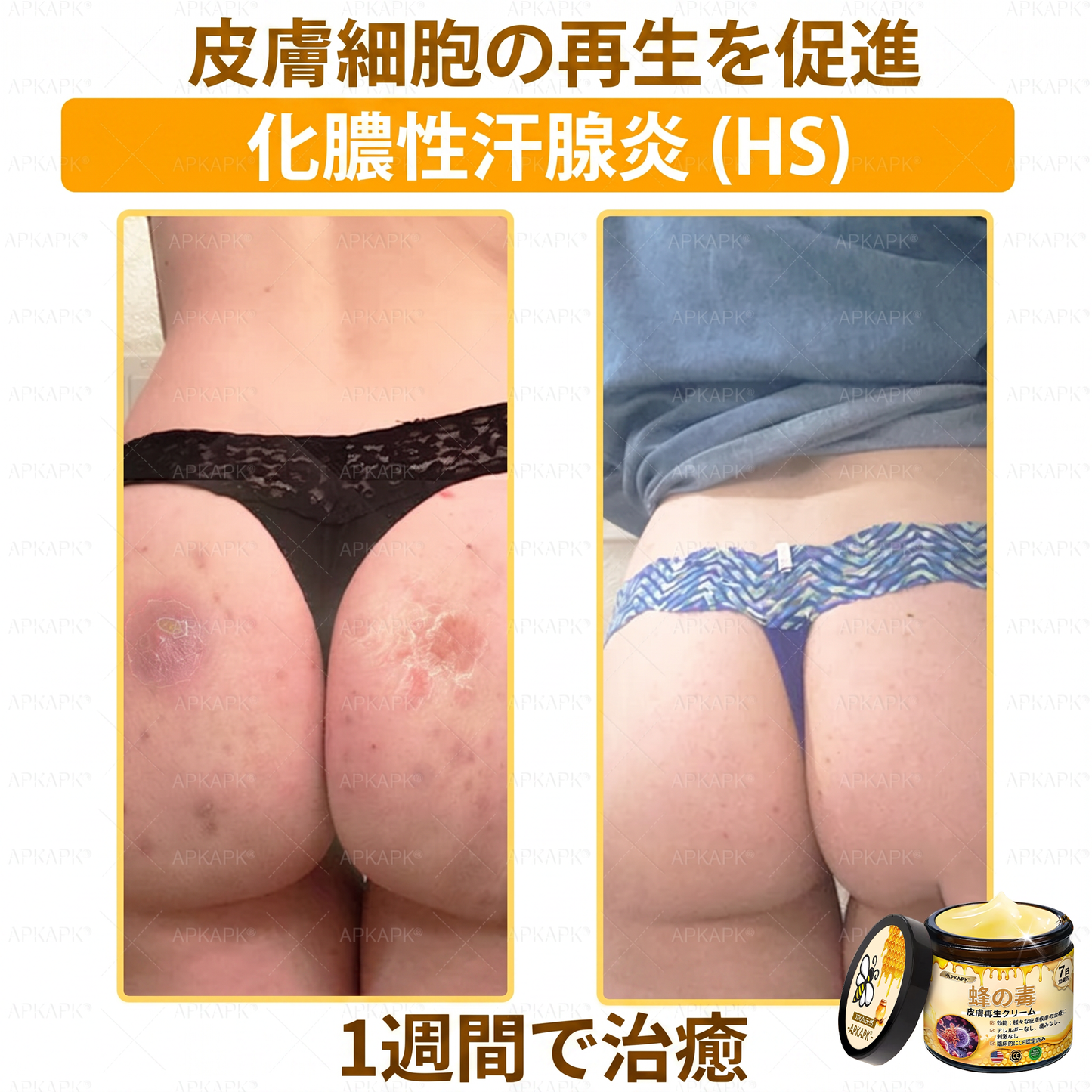 🐝皮膚科学的および臨床的にテスト済み👩‍⚕️APKAPK™ 蜂毒 (ハチドク)   肌再生クリーム🐝 シワ、傷跡、色素沈着、妊娠線、ニキビ、乾癬、湿疹、皮膚の変調、刺激、炎症、その他の皮膚トラブルといった問題の治療に役立ちます🎈