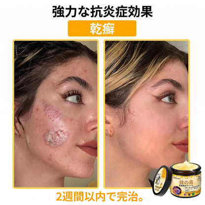 🐝皮膚科学的および臨床的にテスト済み👩‍⚕️APKAPK™ 蜂毒 (ハチドク)   肌再生クリーム🐝 シワ、傷跡、色素沈着、妊娠線、ニキビ、乾癬、湿疹、皮膚の変調、刺激、炎症、その他の皮膚トラブルといった問題の治療に役立ちます🎈