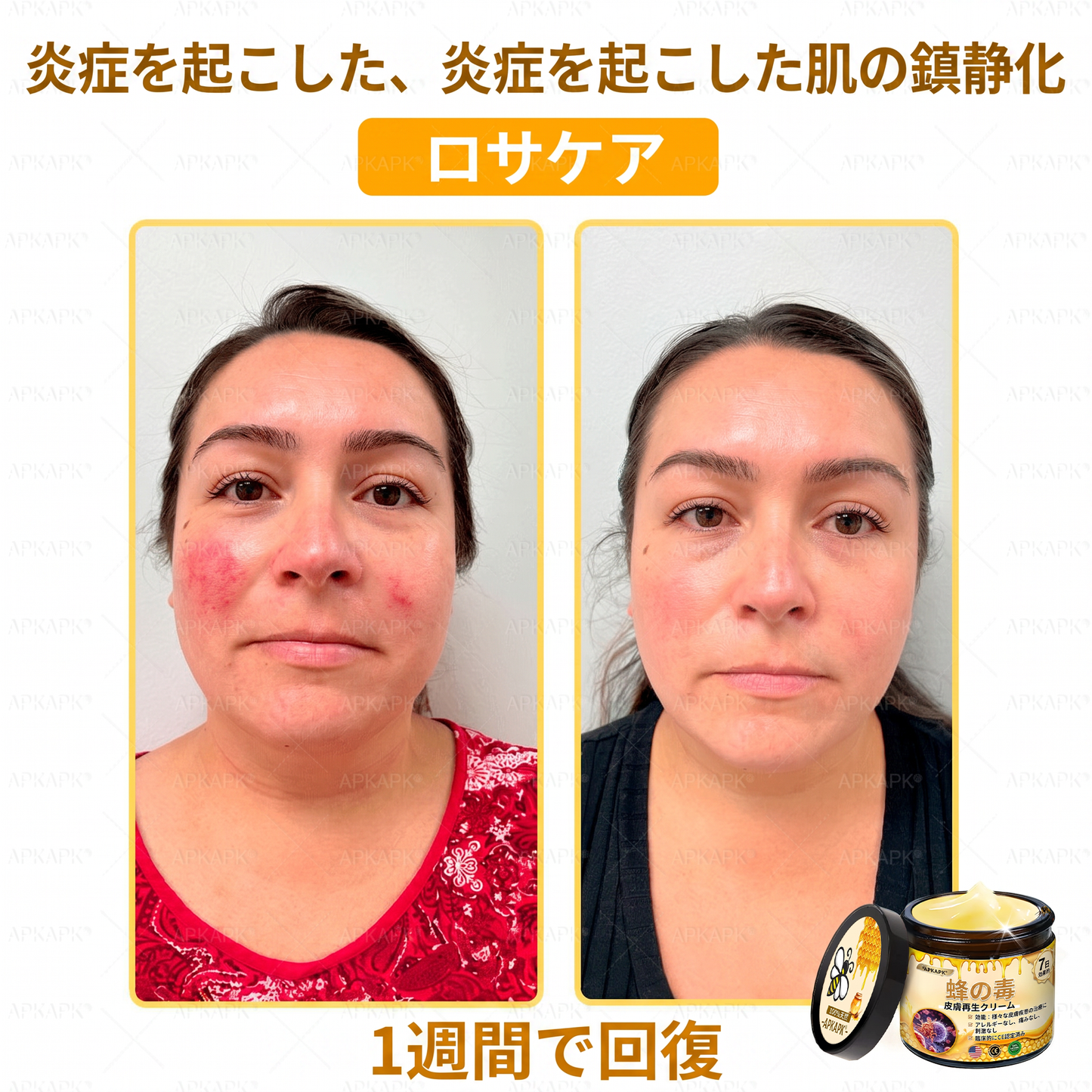 🐝皮膚科学的および臨床的にテスト済み👩‍⚕️APKAPK™ 蜂毒 (ハチドク)   肌再生クリーム🐝 シワ、傷跡、色素沈着、妊娠線、ニキビ、乾癬、湿疹、皮膚の変調、刺激、炎症、その他の皮膚トラブルといった問題の治療に役立ちます🎈