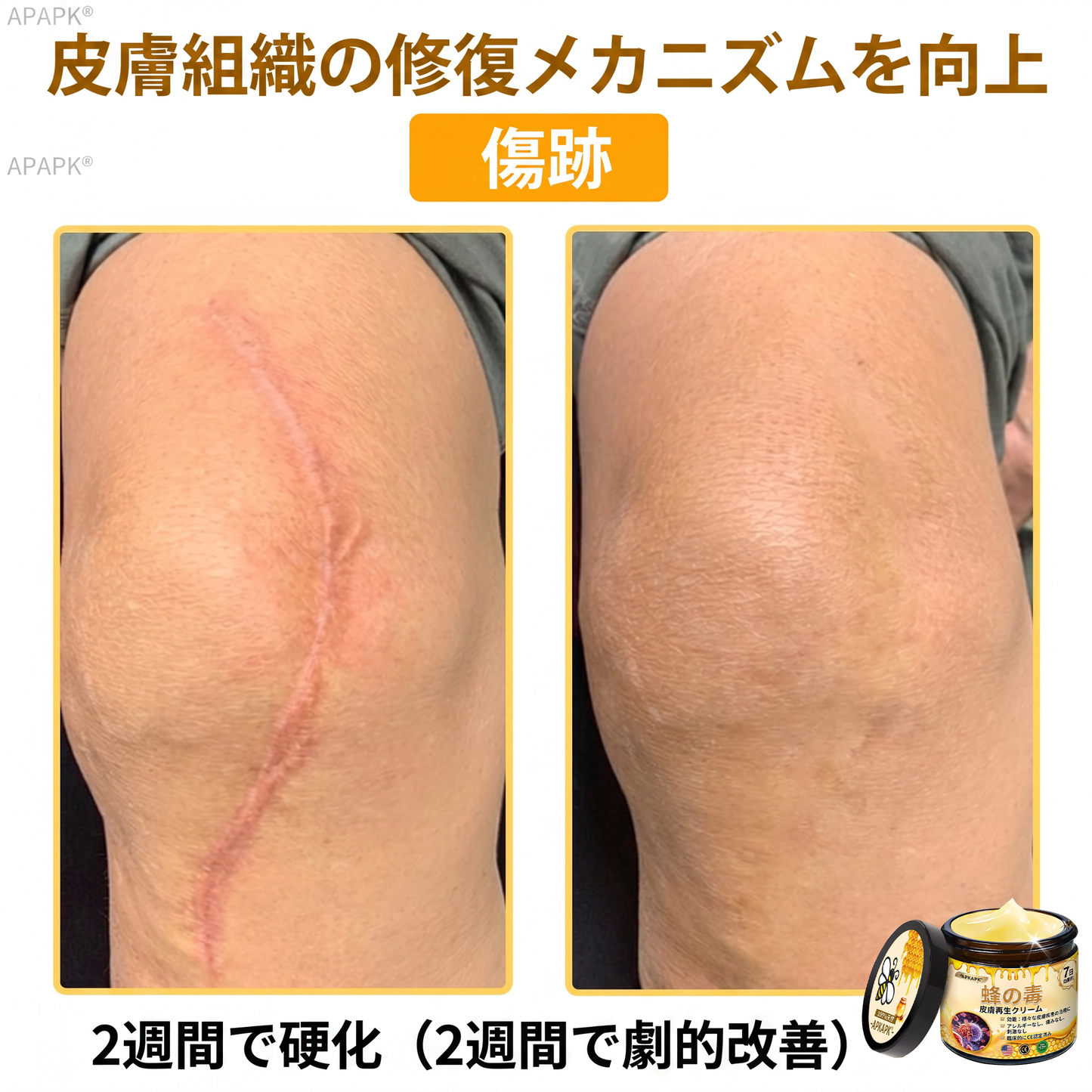 🐝皮膚科学的および臨床的にテスト済み👩‍⚕️APKAPK™ 蜂毒 (ハチドク)   肌再生クリーム🐝 シワ、傷跡、色素沈着、妊娠線、ニキビ、乾癬、湿疹、皮膚の変調、刺激、炎症、その他の皮膚トラブルといった問題の治療に役立ちます🎈
