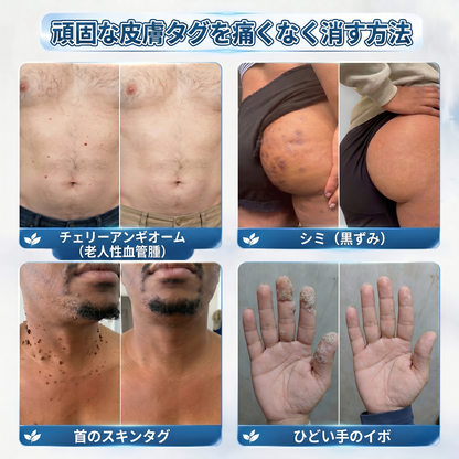 🍧公式ブランドストア  𝐏i𝐜𝐝o® 𝟕日間イボ&シミ消し(痛みも傷跡もゼロのローラーボール)
