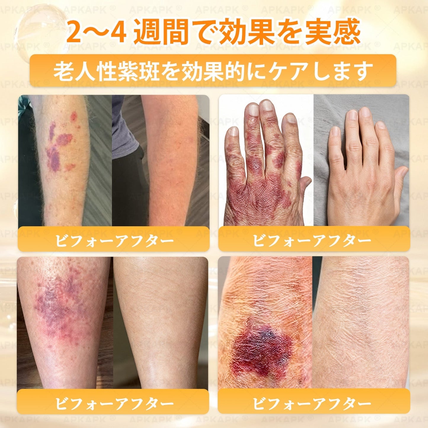 🐝皮膚科学的および臨床的にテスト済み👩‍⚕️APKAPK™ 蜂毒 (ハチドク)   肌再生クリーム🐝 シワ、傷跡、色素沈着、妊娠線、ニキビ、乾癬、湿疹、皮膚の変調、刺激、炎症、その他の皮膚トラブルといった問題の治療に役立ちます🎈