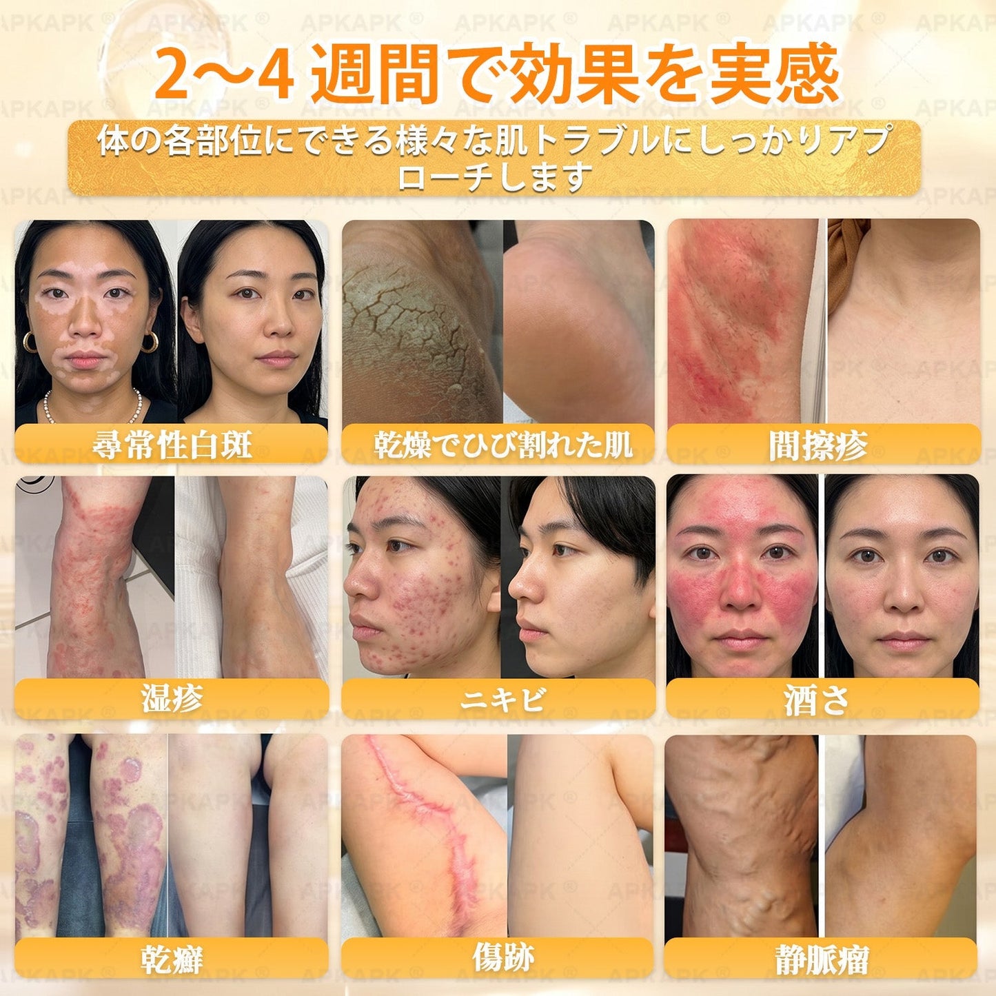 🐝皮膚科学的および臨床的にテスト済み👩‍⚕️APKAPK™ 蜂毒 (ハチドク)   肌再生クリーム🐝 シワ、傷跡、色素沈着、妊娠線、ニキビ、乾癬、湿疹、皮膚の変調、刺激、炎症、その他の皮膚トラブルといった問題の治療に役立ちます🎈