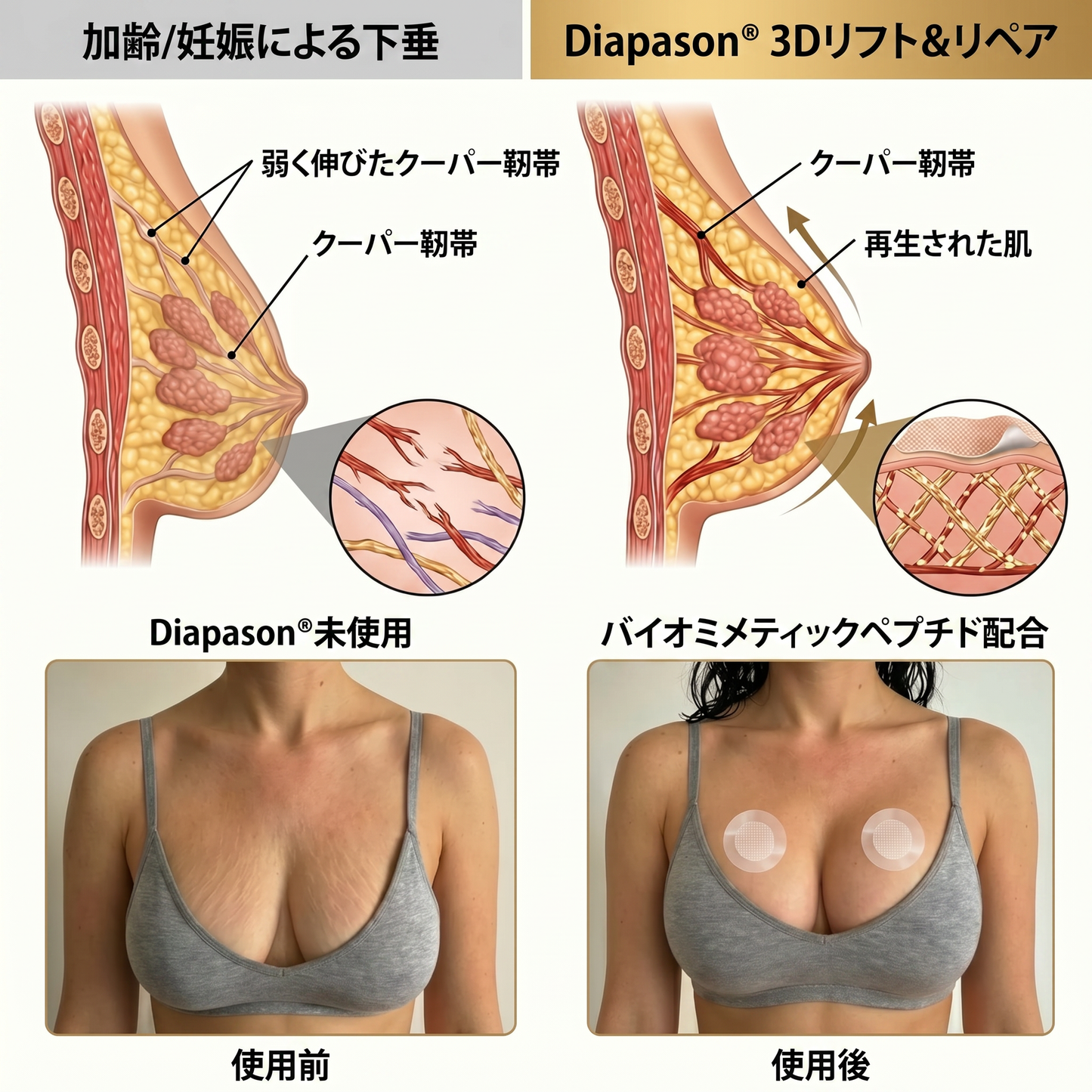 💥Diapason® 💥バストボリューム アップ＆ハリ向上 マイクロニードルパッチ💥💥💥