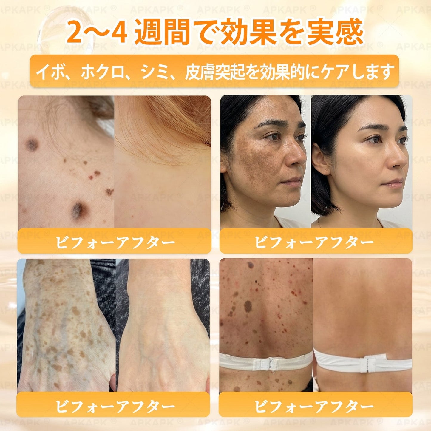 🐝皮膚科学的および臨床的にテスト済み👩‍⚕️APKAPK™ 蜂毒 (ハチドク)   肌再生クリーム🐝 シワ、傷跡、色素沈着、妊娠線、ニキビ、乾癬、湿疹、皮膚の変調、刺激、炎症、その他の皮膚トラブルといった問題の治療に役立ちます🎈