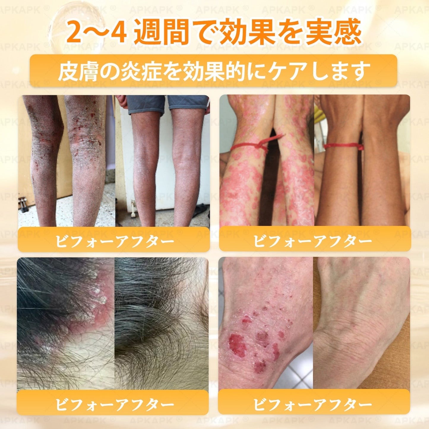 🐝皮膚科学的および臨床的にテスト済み👩‍⚕️APKAPK™ 蜂毒 (ハチドク)   肌再生クリーム🐝 シワ、傷跡、色素沈着、妊娠線、ニキビ、乾癬、湿疹、皮膚の変調、刺激、炎症、その他の皮膚トラブルといった問題の治療に役立ちます🎈